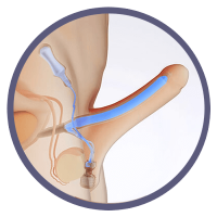 Penile Prostheses
